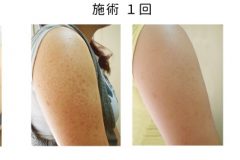 毛孔性苔癬