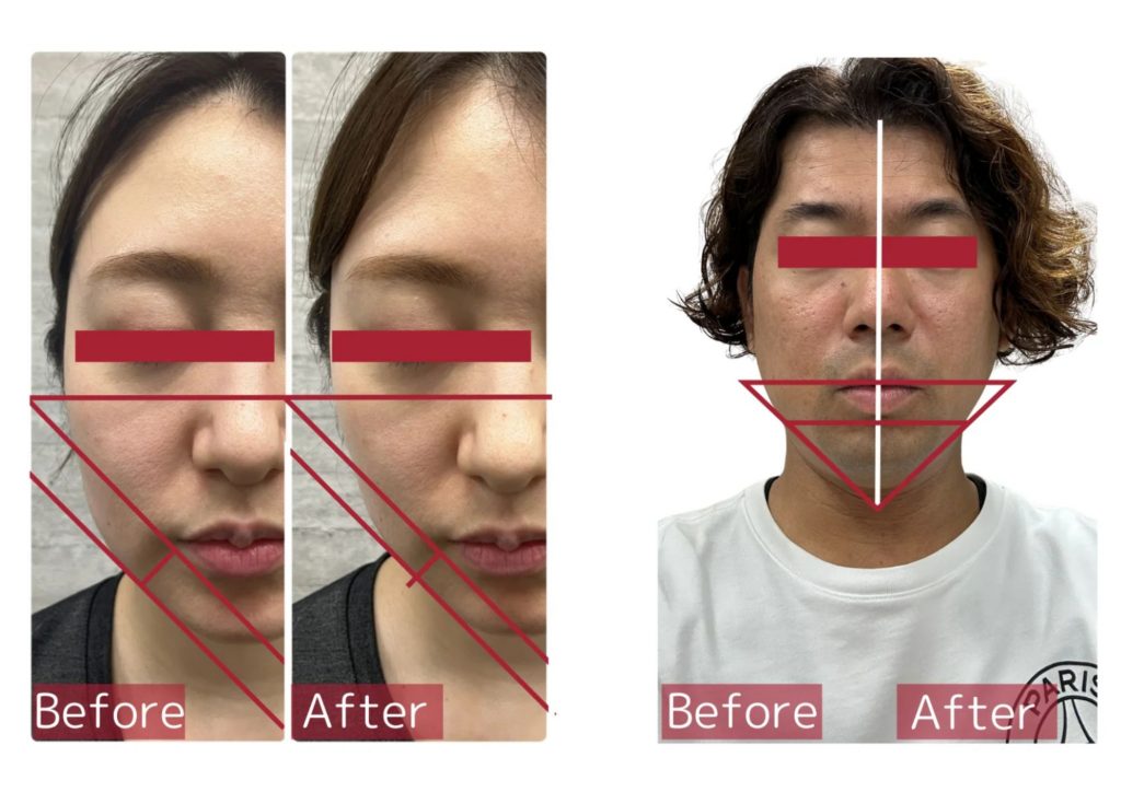 二重あご・フェイスライン脂肪にアプローチ
